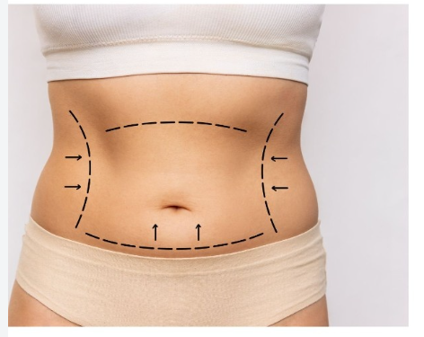 Tummy Tuck