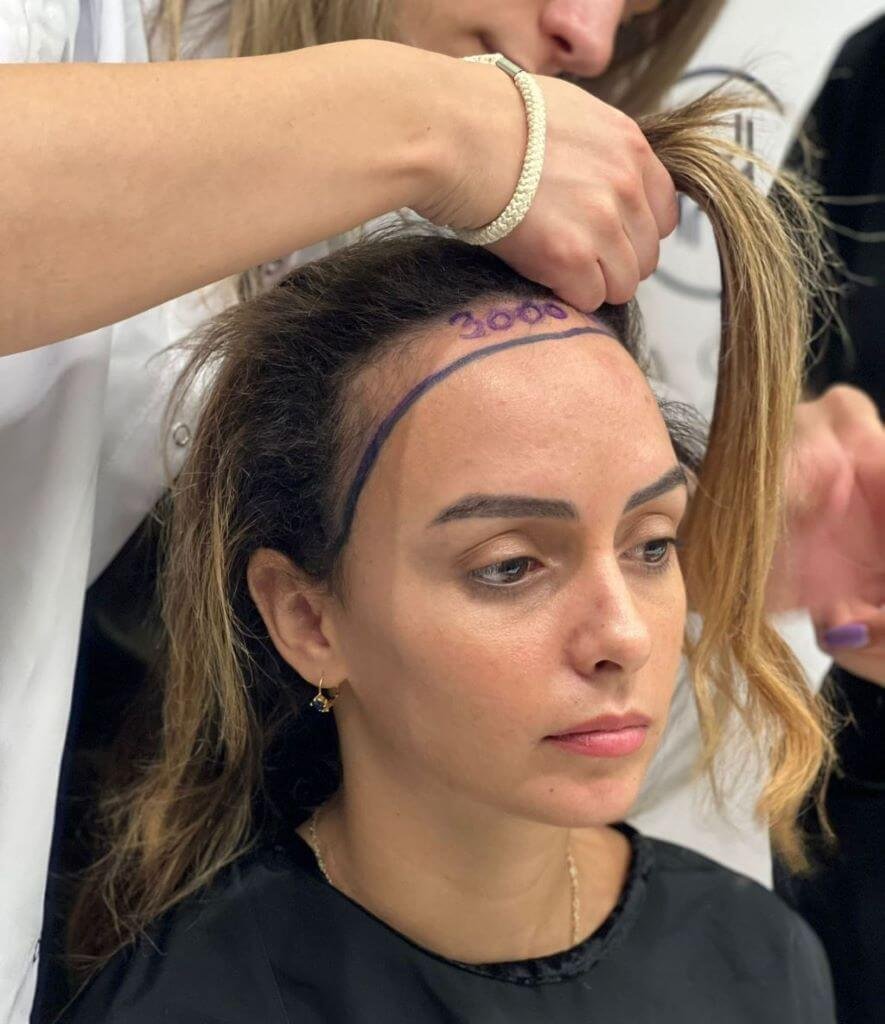 Woman scalp thinning near parting — Female Hair Transplant