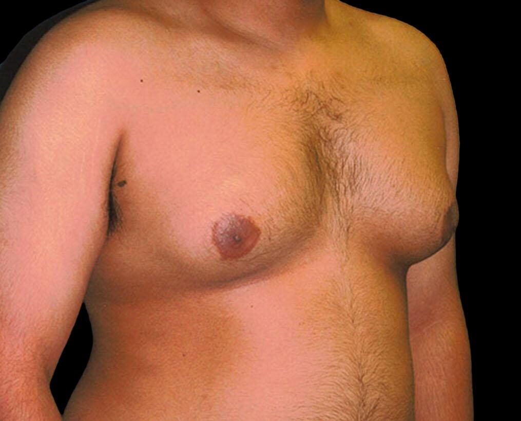 Gynecomastia