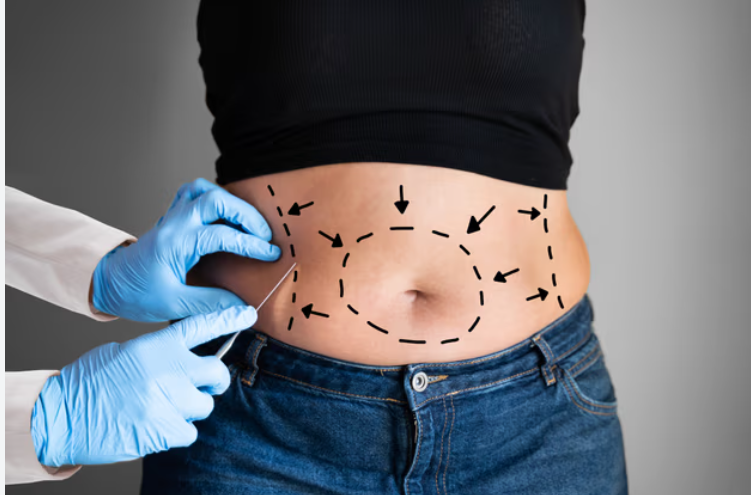 Liposuction