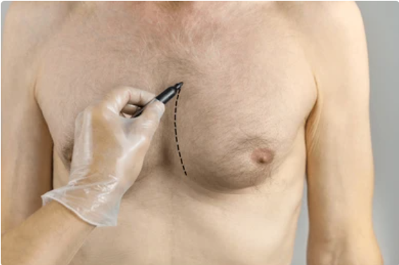 Male breast reduction treatment