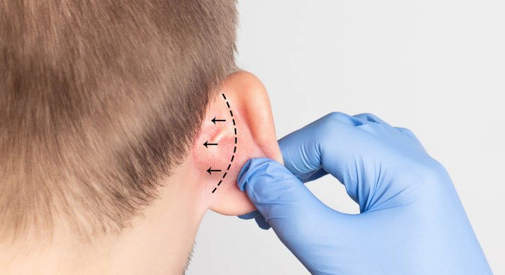 Side portrait showing the ear — Otoplasty