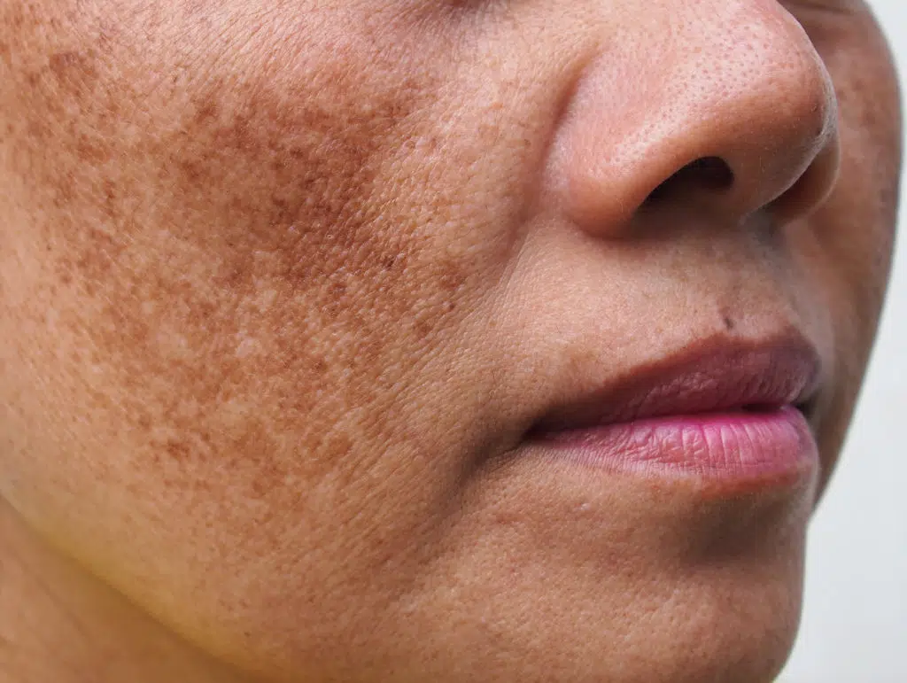 Visible uneven skin tone — Pigmentation