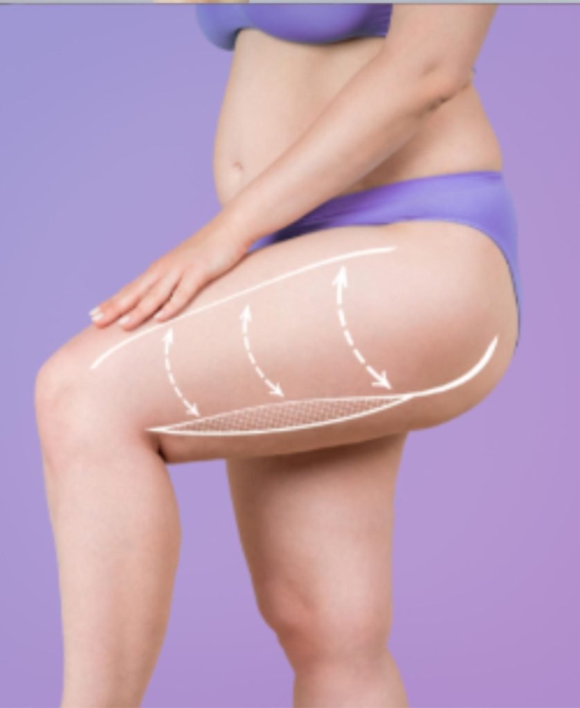 Lower body contour image — Thigh Lift