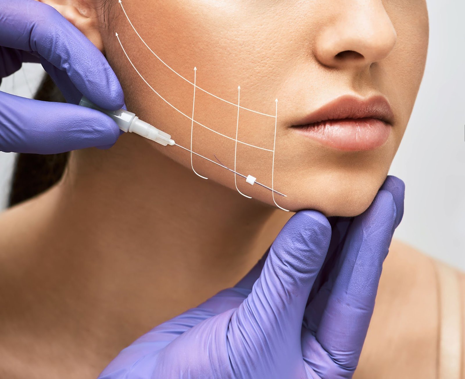 Thread lift treatment — Threads